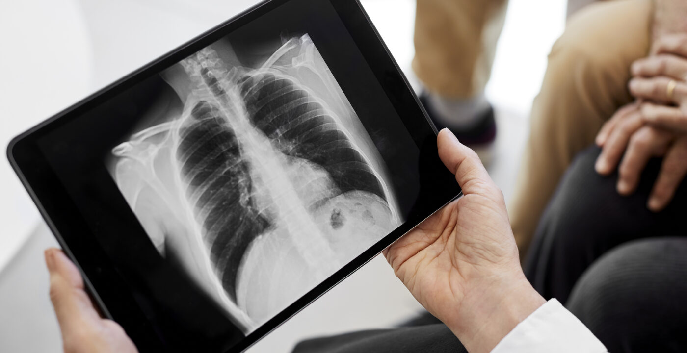 Chest x ray