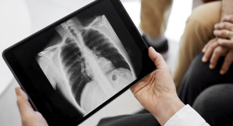 Chest x ray