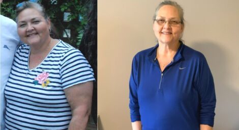Woman before and after 80-pound weight loss