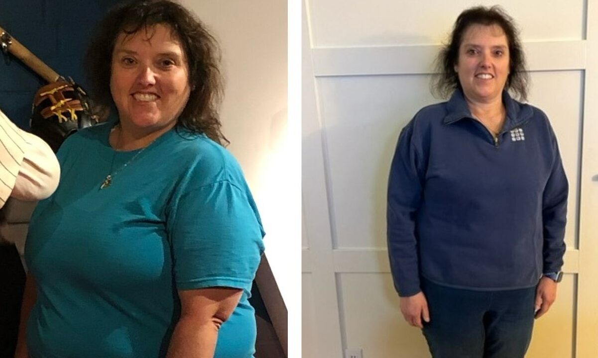 Woman before and after bariatric surgery
