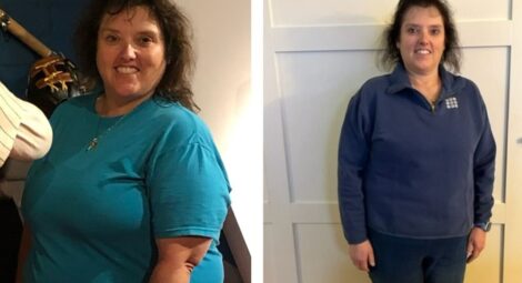 Woman before and after bariatric surgery