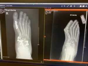 X-rays of foot before and after surgery 