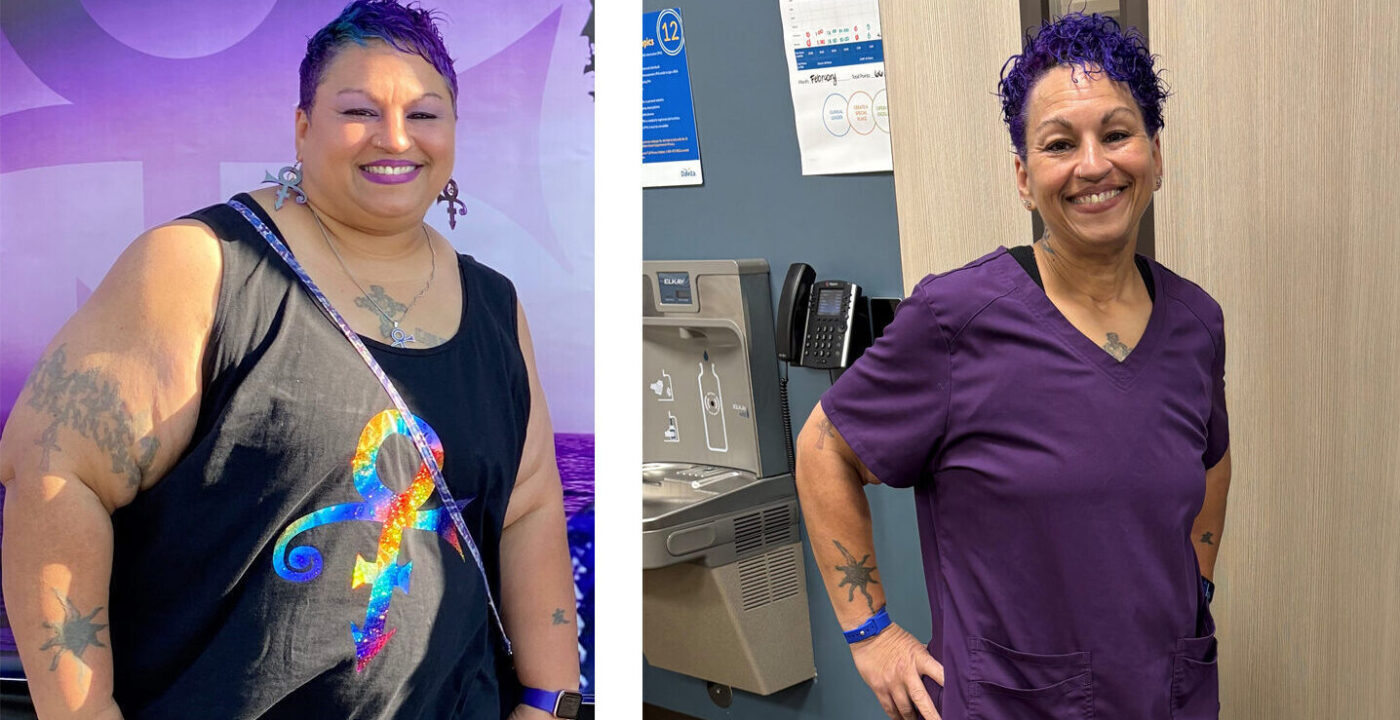 Side-by-side images of woman before and after bariatric surgery