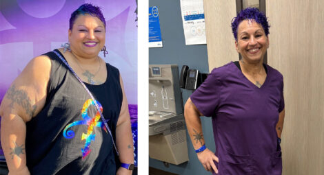 Side-by-side images of woman before and after bariatric surgery
