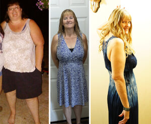 Before and after picture of Marjorie prior to weight loss surgery, and after at a smaller size with excess skin removed.