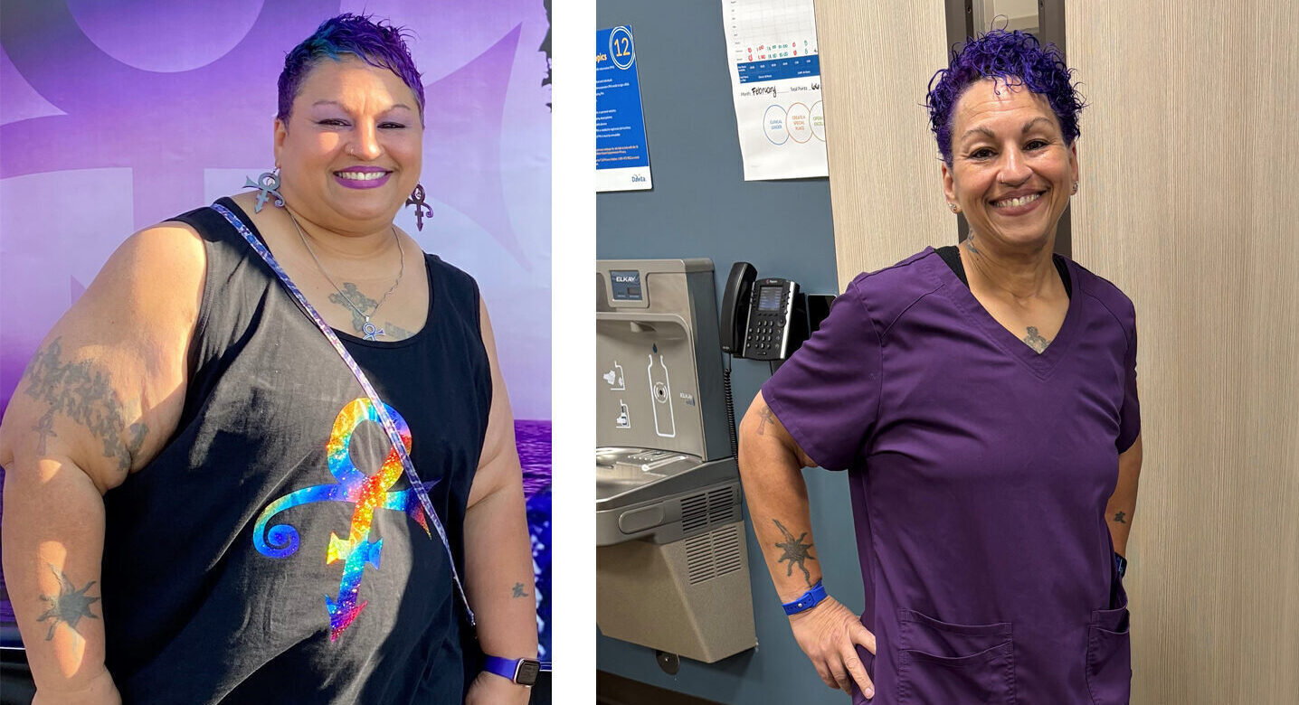 Side-by-side images of woman before and after bariatric surgery